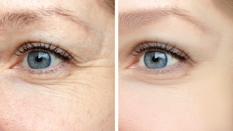 Eyes & Face Wrinkles