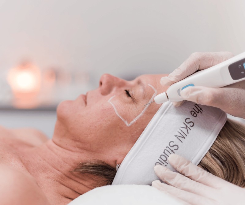 Premier Microneedling Services in San Diego | Prophecy Med Spa