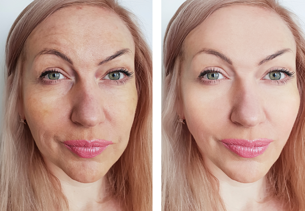 Laser Skin Resurfacing in San Diego | Prophecy Med Spa